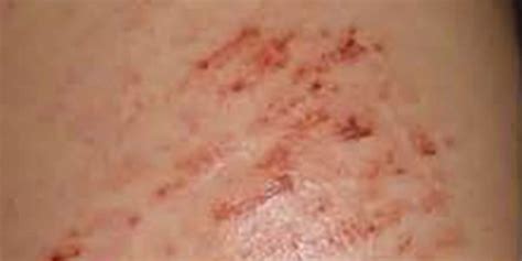 Liver Disease Itchy Skin Rash