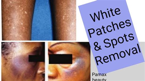 How To Get Rid Of White Patches Bleaching Cream Reactions And Unify