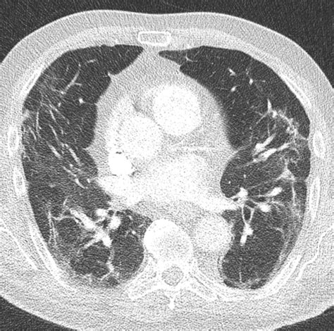 Chest Ct In Covid 19 What The Radiologist Needs To Know Radiographics