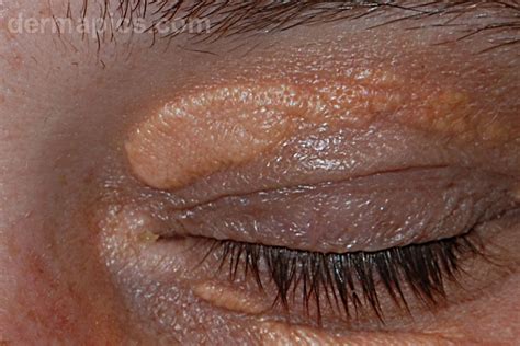 Yellow Eyelids Xanthelasma High Resolution Pictures And Clinical