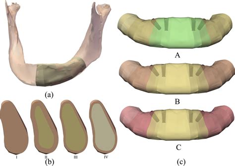 A The Mandible Model Was Created From A Patient ‘s Cbct Data Mirrored