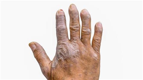 Qu Es La Artritis Psori Sica S Ntomas Causas Y C Mo Tratar