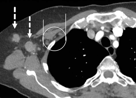 Imaging Updates To Breast Cancer Lymph Node Management Radiographics