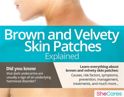 Brown And Velvety Skin Patches Shecares