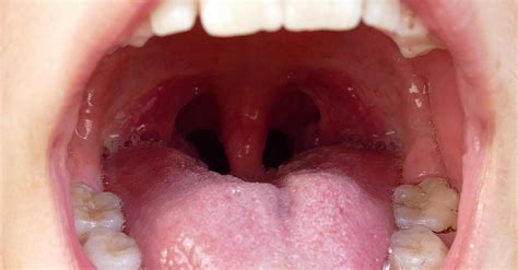 Bakterie z ust mogą zaatakować