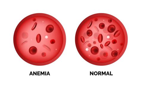 Low Hematocrit And Hemoglobin Levels Indicate Mokasinresources