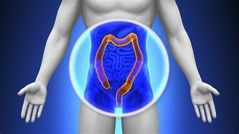 How To Lower The Risk Of Colorectal Cancer If You Have Crohns Disease