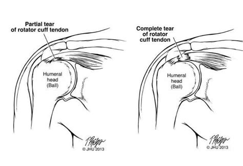 Managing Rotator Cuff Tears Md Health