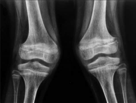 Genu Valgum Treatment Options For Knocked Knees Eshealthtips
