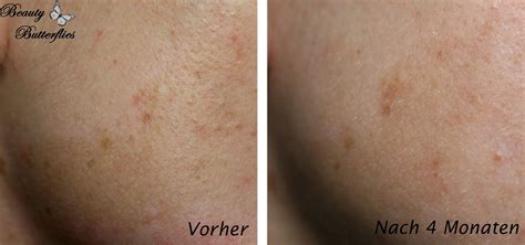 Nach 3 wochen behandlung von unreinheiten und. Review Garnier - Dunkle Flecken Reduzierer