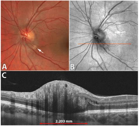 Juxtapapillary Retinal Hemangioblastoma Os A Fundus Photograph