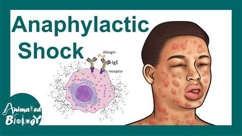 Anaphylactic Shock Anaphylactic Reaction Symptoms And Treatment