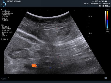 Vietnamese Medic Ultrasound Case 421 Epigastric Hernia Dr Phan Thanh