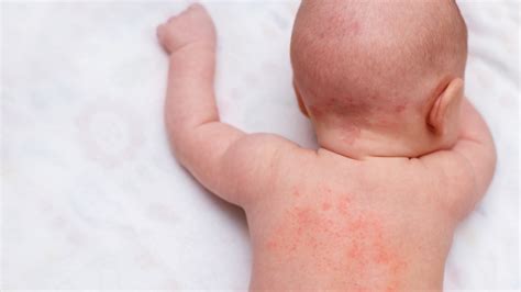 Kenali Berbagai Macam Gejala Jenis Alergi Kulit Pada Bayi Dan Anak