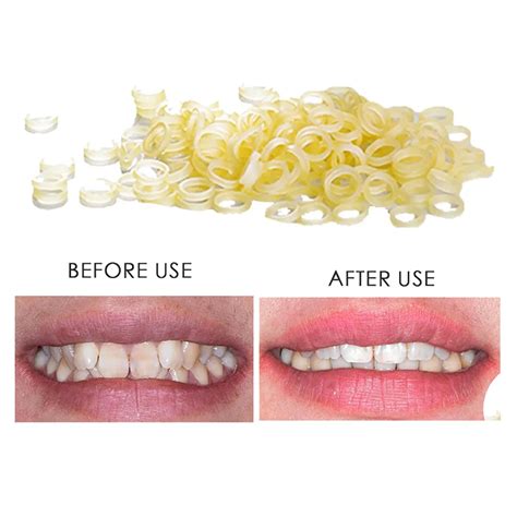 100 Pcs Dental Rubber Bands Orthodontic Elastics Braces Teeth Gap Hot