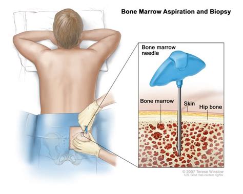 Bone Marrow Transplantation Its Cost In India The Medical Trip