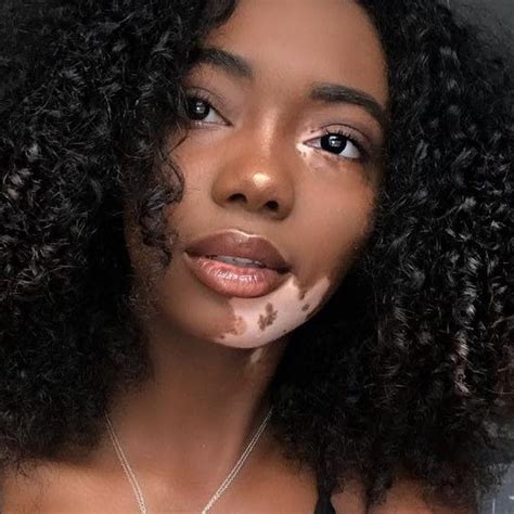 Women With Vitiligo Are Finally Feeling Seen Vitiligo Low Porosity