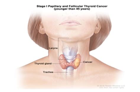 Thyroid Cancer Carcinoma Of The Thyroid