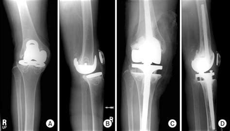 Radiographs Of The Knee With Severe Bone Loss And Osteolysis Combined