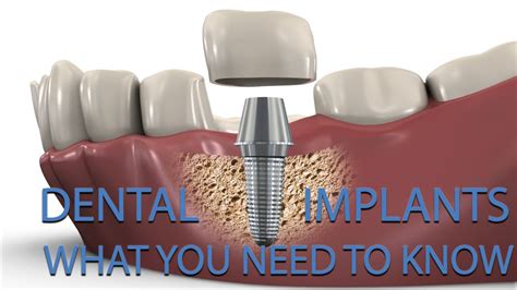 Top 3 Questions About Dental Implants Answered Youtube