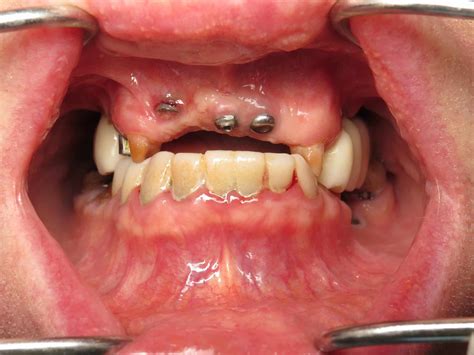 Gum Grafttransplant For Dental Implants Is It Necessary