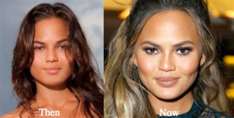 Chrissy Teigen Plastic Surgery Before And After Photos Latest Plastic