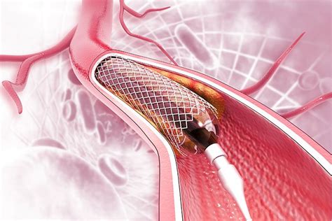 What Is A Stent And Why Would You Need One Edward Elmhurst Health