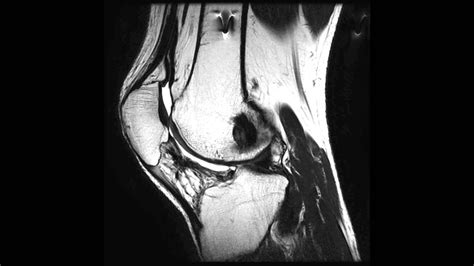 Optimized High Resolution Fast Spin Echo Knee T2 Mri Youtube