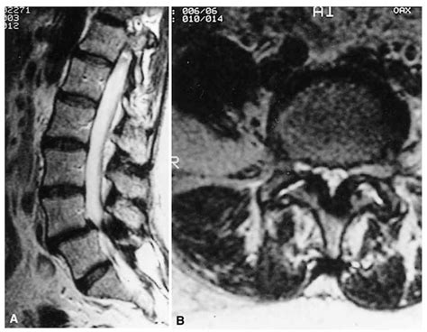 Approach To The Patient With Low Back Pain Lumbosacral Radiculopathy