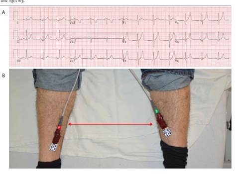 Figure 8 From Common Ecg Lead Placement Errors Part I Limb Lead