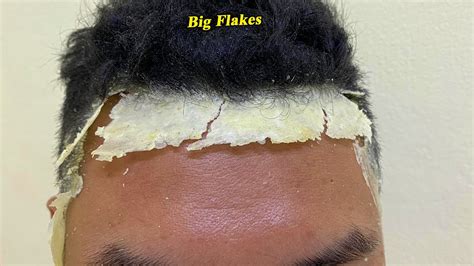 Dry Scalp Big Flakes Dandruff Scratching Satisfying Video 811 Youtube