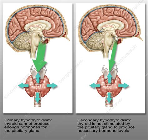 Primary And Secondary Hypothyroidism Illustration Stock Image C0436111 Science Photo Library