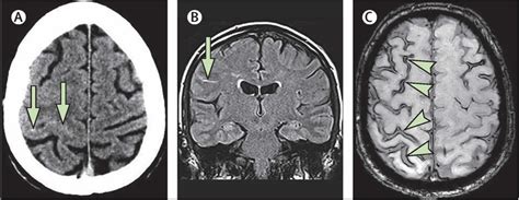 Subarachnoid Hemorrhage Causes Symptoms Diagnosis Treatment And Prognosis