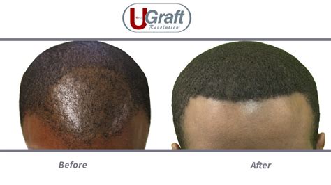 Black female hair transplant before and after. Video: Best Black Hair Transplant | Dr.UGraft Patient Cases