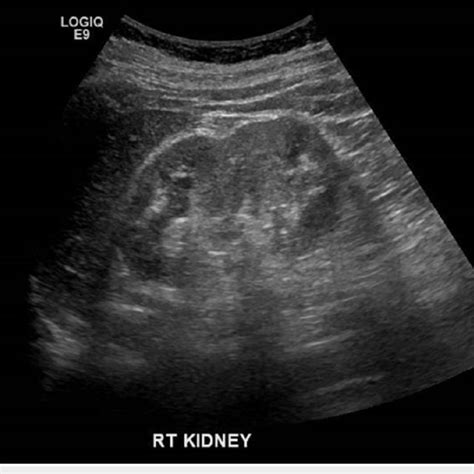 Noncontrast Ct Kub Showing Enlarged Right Kidney With Perinephric Fat
