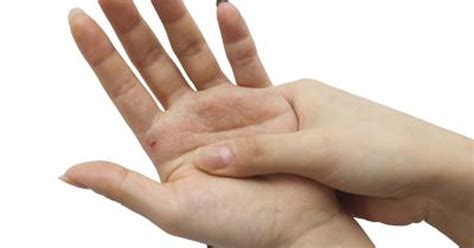 The problem is that unless a food allergy is diagnosed, skin rashes can keep recurring. Allergy & Itchy Hands and Feet | LIVESTRONG.COM