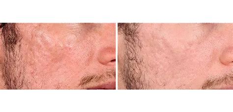 Skin Resurfacing Luxe Laser Portland Oreon Medical Spa