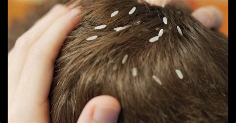 11 Things You Need To Know About Head Lice Infographi