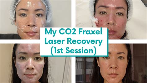I Finally Got Co2 Fraxel Laser For My Atrophic Acne Scars Recovery