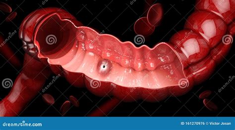 Ulcera Peptica Illustrazione D Dell Anatomia Dello Stomaco Umano