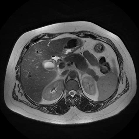 Acute Calcular Cholecystitis And Mirizzi Syndrome Image Radiopaedia Org