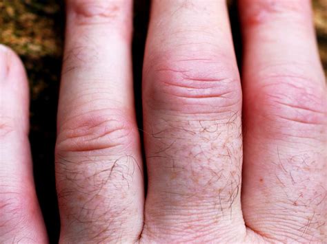 Psoriatic Arthritis In The Hands Symptoms Pictures And
