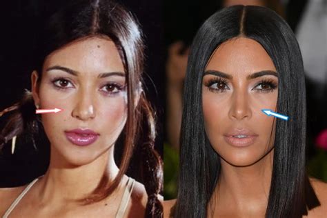 Kim Kardashian Nose Job Before And After Surgery Rhinoplasty