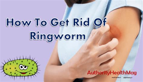 How To Get Rid Of Ringworm Fast Home Treatment And Medicines