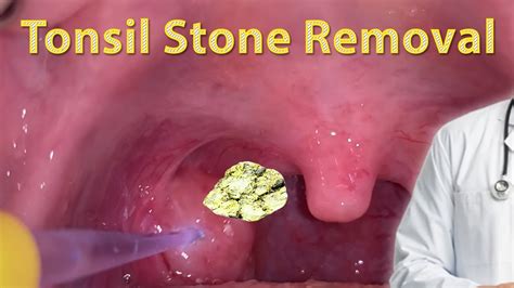 Tonsil Stones Aka Tonsilloliths Youtube