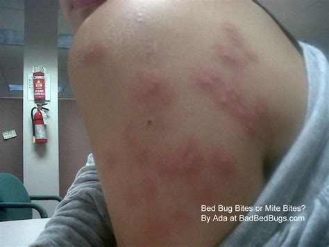 They bite humans in failed attempts to lay their eggs. What do bed bugs bites look like? Like this!