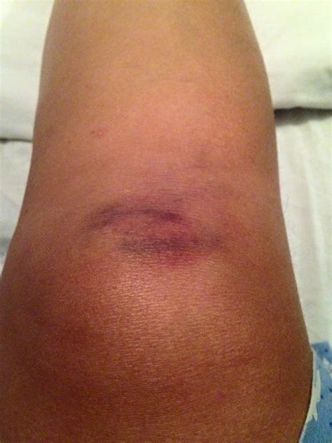 Bruise On Leg With Lump Underneath