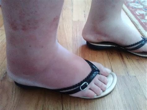 Swollen Feet Ankles Lower Legs With Rash Vasculitis Uk My XXX Hot Girl