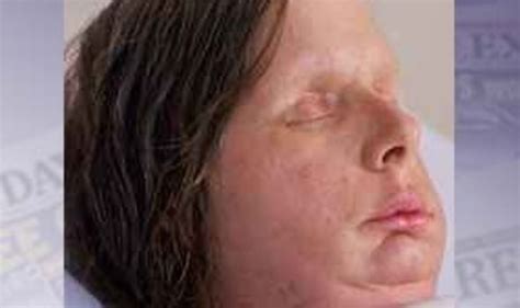 Chimp Attack Woman Reveals New Face World News Uk