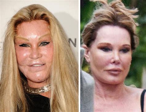 Jocelyn Wildenstein Cat Woman Plastic Surgery Before And After